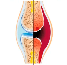 A estrutura de uma articulação saudável e desgastada com a designação de tecido cartilaginoso e líquido sinovial