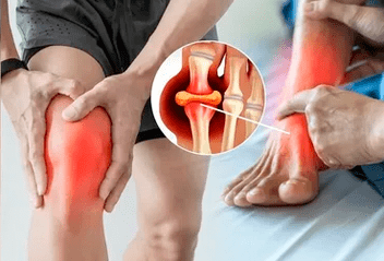 Esquema para aplicação do gel Icexin na região da articulação do joelho e pé