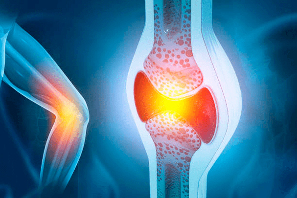 Prevenção de doenças articulares